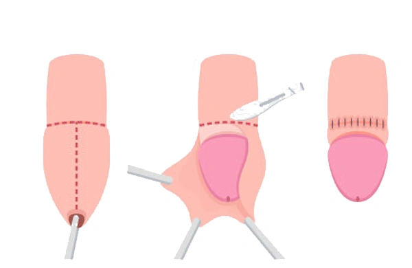 Circumcision Treatment