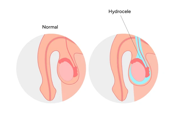 Hydrocele Treatment