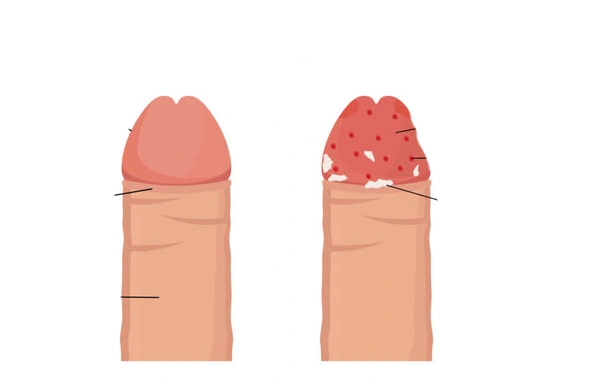 Balanitis Care