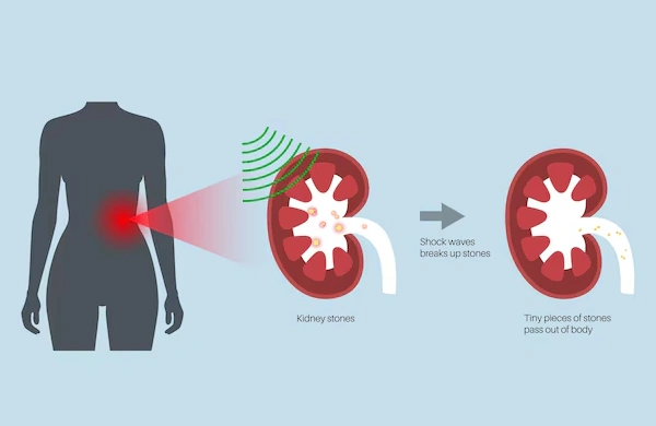 Lithotripsy Treatment