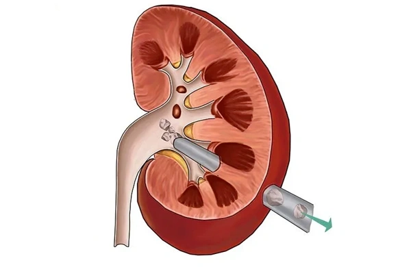 PCNL