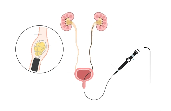 Ureterorenoscopy